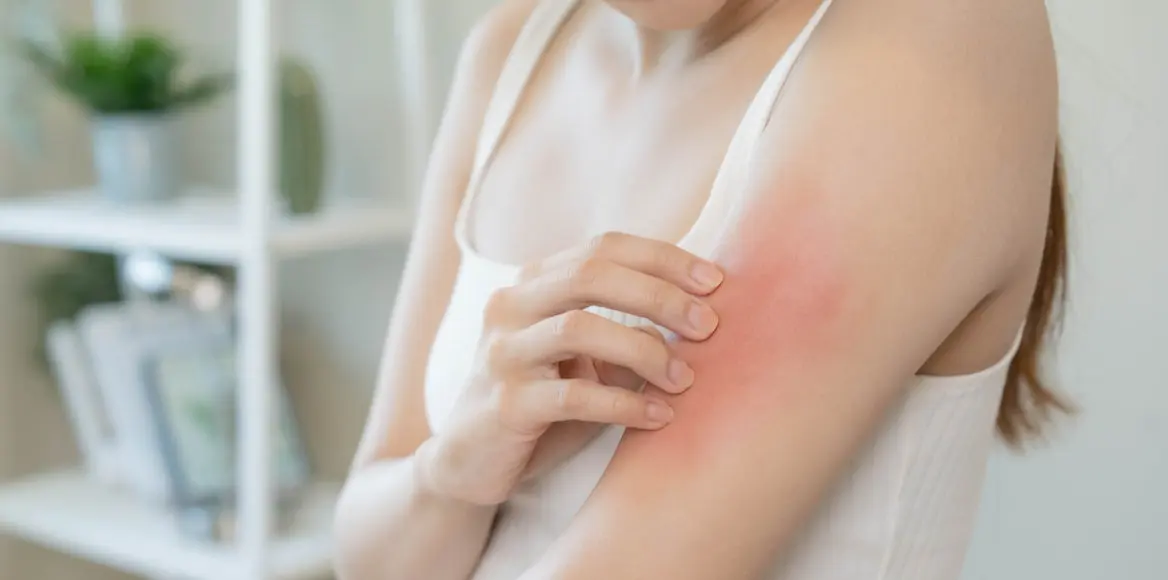 aurinkoihottuma-punoittaa-ja-kutisee